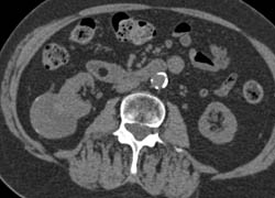 Renal Cell Carcinoma Arises in A Cyst - CTisus CT Scan