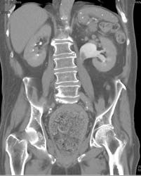Transitional Cell Carcinoma - CTisus CT Scan