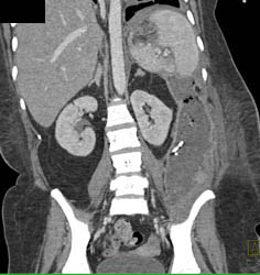 Abscess in Left Perirenal Space - CTisus CT Scan