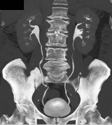 Ct Urogram With Prominent Medullary Rays - CTisus CT Scan