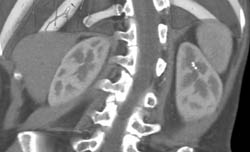 Renal Calculi With Papillary Necrosis Upper Pole Calyces on the Left- See Sequence - CTisus CT Scan