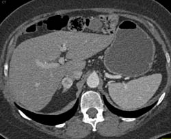 Recurrent Renal Cell Carcinoma With Vascular Metastases to Right Adrenal Gland and Left Para-aortic Nodes - CTisus CT Scan