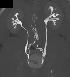 Normal CT Urogram - CTisus CT Scan