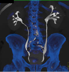 Normal CT Urogram - CTisus CT Scan