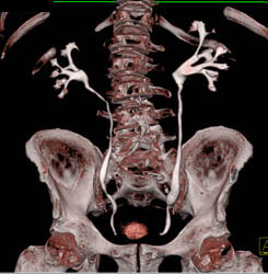 Normal CT Urogram - CTisus CT Scan