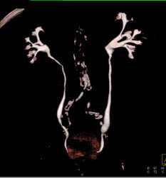 Normal CT Urogram - CTisus CT Scan