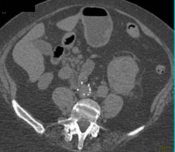 Renal Cell Carcinoma - CTisus CT Scan