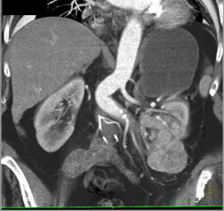Renal Cell Carcinoma - CTisus CT Scan