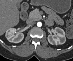 Scarring Kidney Due to Papillary Necrosis- See CT Urogram for Best Detail in Full Sequence - CTisus CT Scan