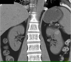 High Density Renal Cysts Left Kidney and Pain Probe in Spinal Canal - CTisus CT Scan