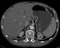 Unusual Vascular Left Adrenal Adenoma Simulates A Renal Cell Carcinoma - CTisus CT Scan