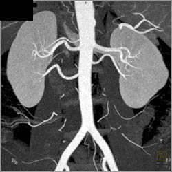 3 Right and 2 Left Renal Arteries - CTisus CT Scan