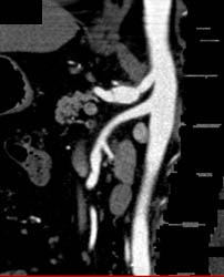 Incidental Celiac Artery Stenosis - CTisus CT Scan