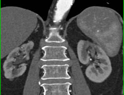 Full Sequence Shows Filling Defect in Upper Pole Calyx on Right. See CT Urogram Images. Transitional Cell Carcinoma of the Kidney. Scarring Right Kidney With Abnormally Blunted Calyces Also - CTisus CT Scan