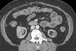 Renal Cell Carcinoma - CTisus CT Scan