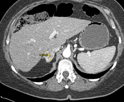Left Nephrectomy With Recurrence to Right Adrenal and Left Renal Bed - CTisus CT Scan