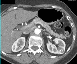 Renal Cell Carcinoma - CTisus CT Scan