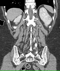 Renal Cell Carcinoma - CTisus CT Scan