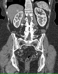Renal Cell Carcinoma - CTisus CT Scan