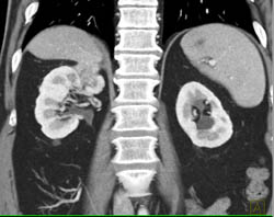 Renal Cell Carcinoma - CTisus CT Scan