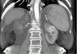 Renal Cell Carcinoma - CTisus CT Scan