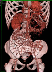 Pelvic Kidney - CTisus CT Scan