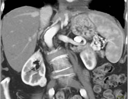 2 Cm Renal Cell Carcinoma With Multiple Phases - CTisus CT Scan