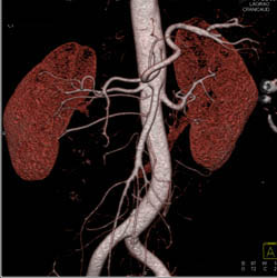 3 Right Renal Arteries in A Transplant Patient - CTisus CT Scan