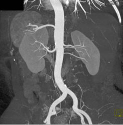 3 Right Renal Arteries in A Transplant Patient - CTisus CT Scan