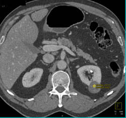 Bosniak Ii Cyst - CTisus CT Scan