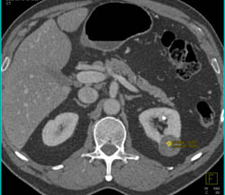 Bosniak Ii Cyst - CTisus CT Scan