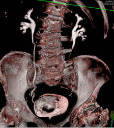 Active Bleed in Bladder Cancer- See Sequence - CTisus CT Scan