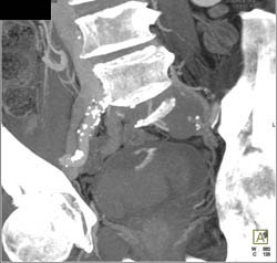 Active Bleed in Bladder Cancer- See Sequence - CTisus CT Scan