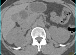 Cystic Renal Cell Carcinoma - CTisus CT Scan