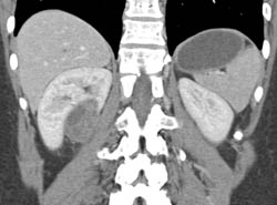 Cystic Renal Cell Carcinoma - CTisus CT Scan