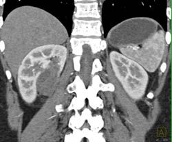Cystic Renal Cell Carcinoma - CTisus CT Scan