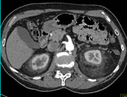 Stranding Around Both Kidneys in Peri and Para-renal Spaces Like ErdheimChester Disease - CTisus CT Scan