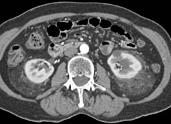 Stranding Around Both Kidneys in Peri and Para-renal Spaces Like ErdheimChester Disease - CTisus CT Scan