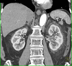 Stranding Around Both Kidneys in Peri and Para-renal Spaces Like ErdheimChester Disease - CTisus CT Scan