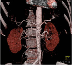 Stranding Around Both Kidneys in Peri and Para-renal Spaces Like ErdheimChester Disease - CTisus CT Scan