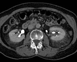 Stranding Around Both Kidneys in Peri and Para-renal Spaces Like ErdheimChester Disease - CTisus CT Scan