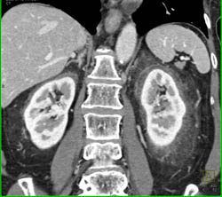 Stranding Around Both Kidneys in Peri and Para-renal Spaces Like ErdheimChester Disease - CTisus CT Scan