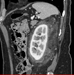 Stranding Around Both Kidneys in Peri and Para-renal Spaces Like ErdheimChester Disease - CTisus CT Scan