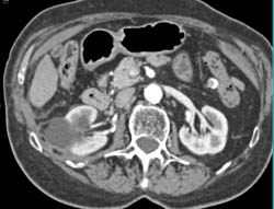 Complex Cystic Changes S/p Radiofrequency Ablation (RFA) - See Sequence - CTisus CT Scan