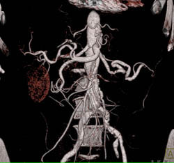 Transitional Cell Carcinoma With Nodes and Infiltration of the Kidney. the Renal Artery Is Encased - CTisus CT Scan