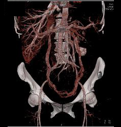 Pelvic Congestion Syndrome With Dilated Gonadal Veins - CTisus CT Scan