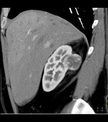 Renal Cell Carcinoma- See Full Sequence - CTisus CT Scan
