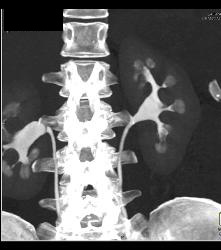 Papillary Blush - CTisus CT Scan