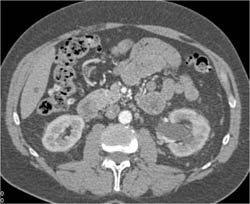 Left Hydronephrosis - CTisus CT Scan