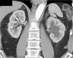 Left Hydronephrosis - CTisus CT Scan